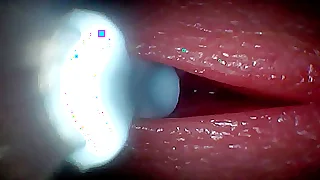 I couldn&rsquo;t believe what happens Medial the penis as sperm passes through &lpar;endoscopic footage&rpar;